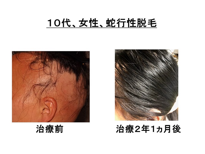 円形脱毛症　病院